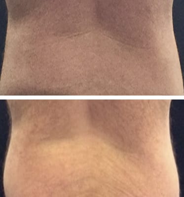 CoolSculpting Los Angeles before and after - back close up