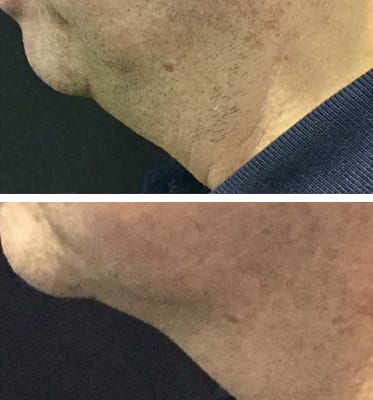 CoolSculpting Los Angeles before and after - chin close up