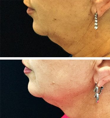 CoolSculpting Los Angeles before and after - chin