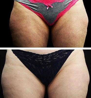 CoolSculpting Los Angeles before and after - thighs