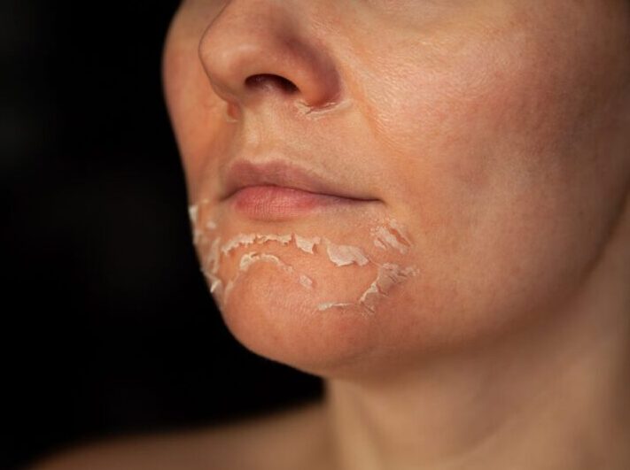 Woman's face after chemical peeling.