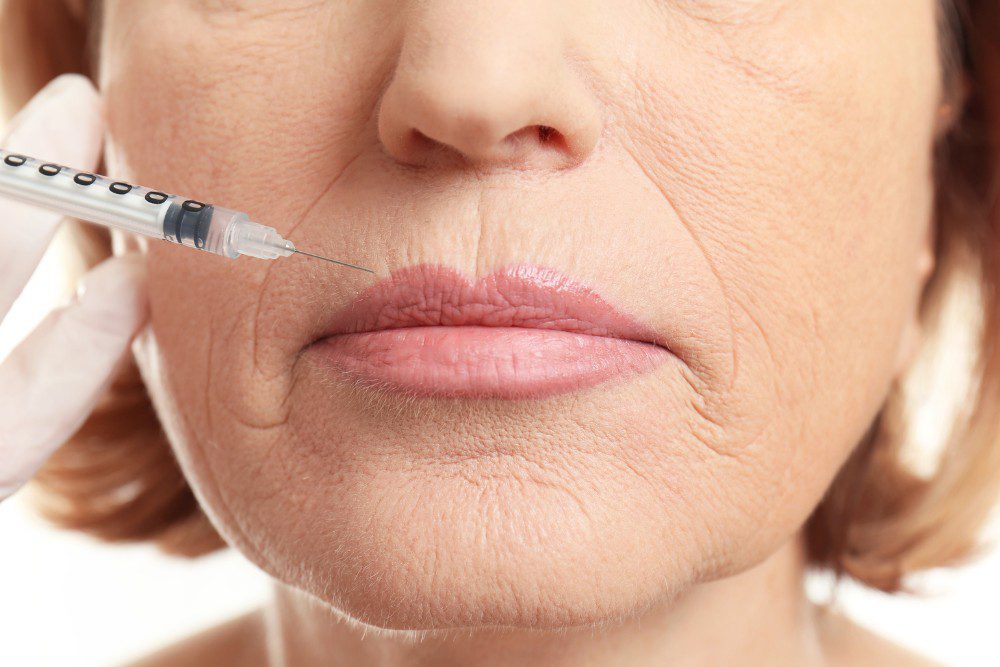 A woman getting Botox for her vertical lip lines.